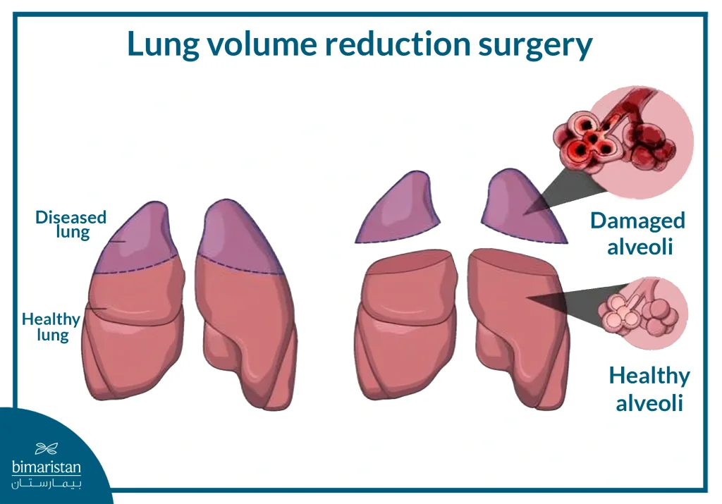 Lung Volume Reduction Surgery
