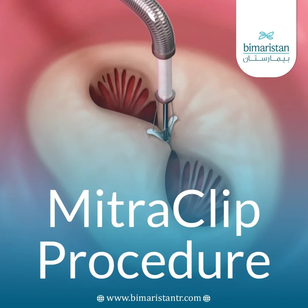 Mitraclip Procedure: A Minimally Invasive Solution For Mitral Valve Regurgitation 5 Mitra Clip Procedure