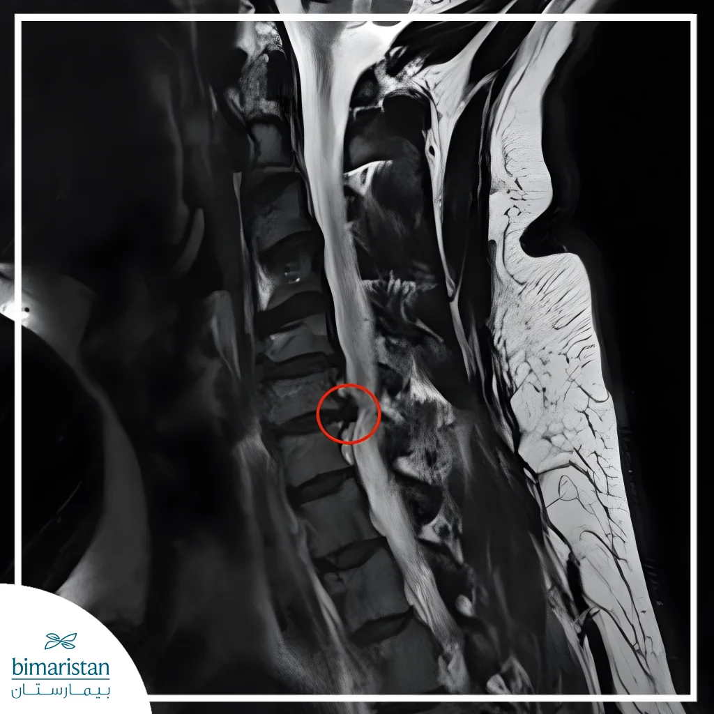 Neck Disc Prevention: Essential Habits To Protect Your Spine 4 Mri Image Showing Cervical Disc Herniation