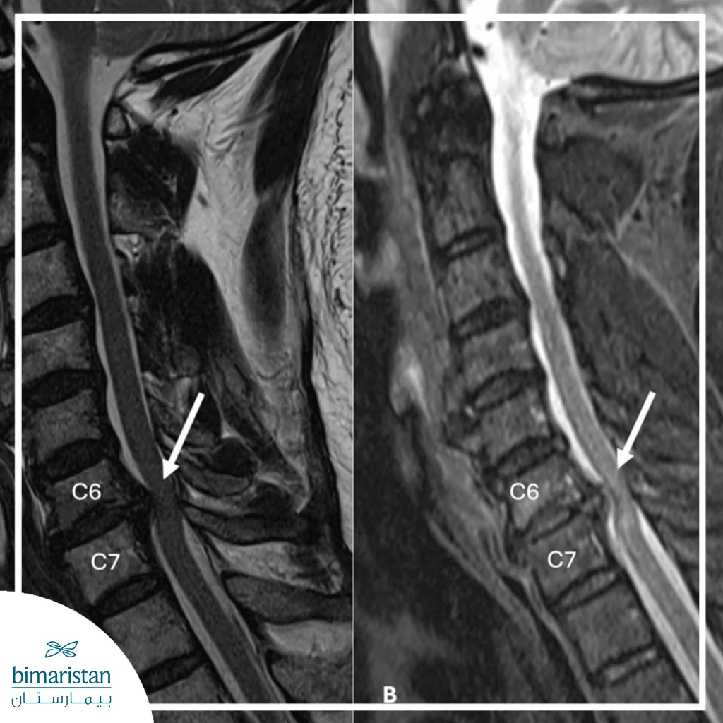 Mri Showing Spinal Cord Compression Due To A Herniated Cervical Disc.