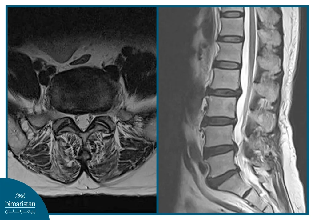 Disc Herniation Types: How Do Intervertebral Injuries Differ And Which Are The Most Serious? 4 Mri Showing Spinal Cord Compression Due To A Herniated Lumber Disc