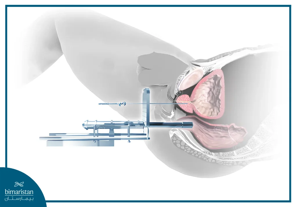 Mechanism Of Low-Dose-Rate Brachytherapy Procedure