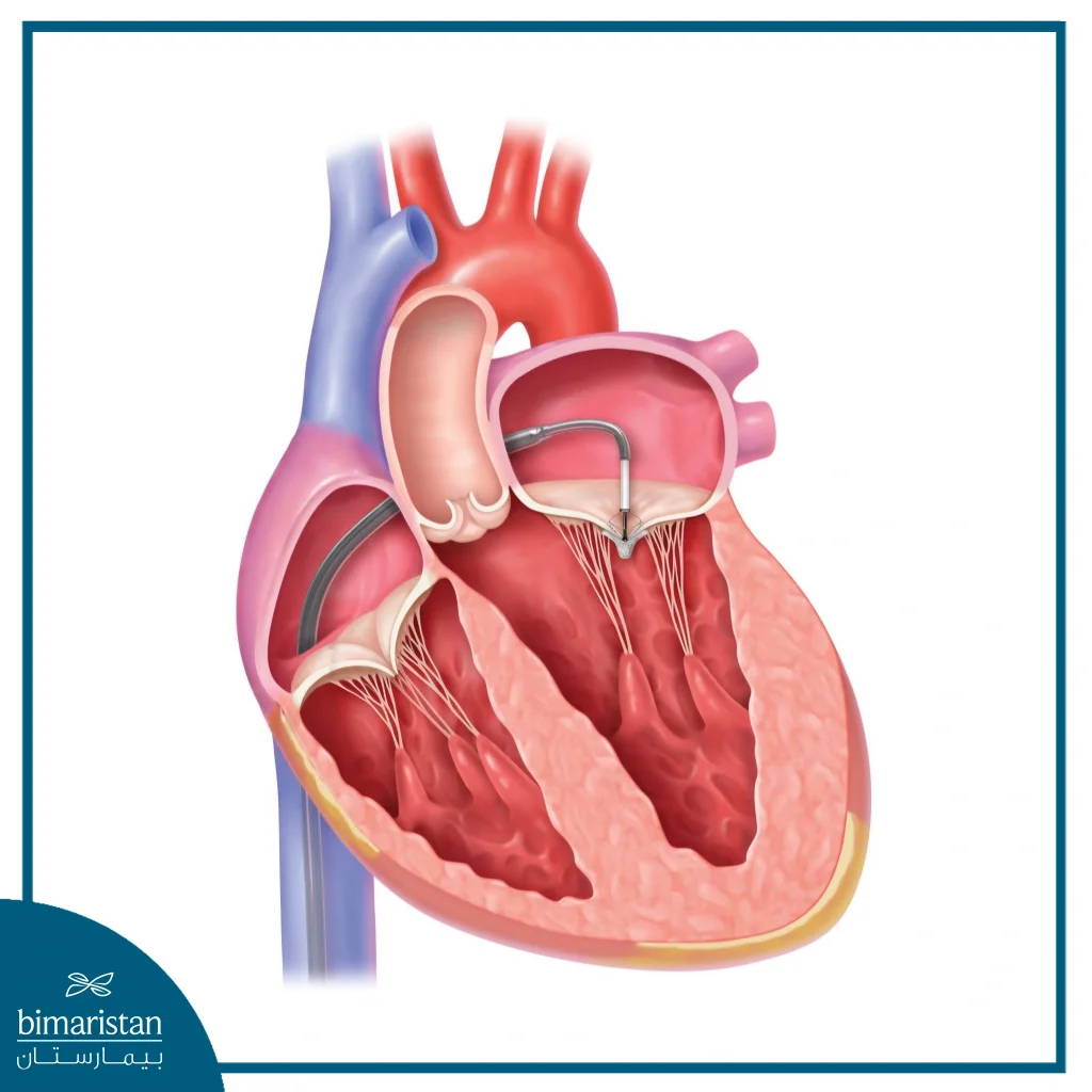 Mitraclip Procedure: A Minimally Invasive Solution For Mitral Valve Regurgitation 3 Medical Illustration Showing Mitraclip Device Guided By Catheter To The Mitral Valve.