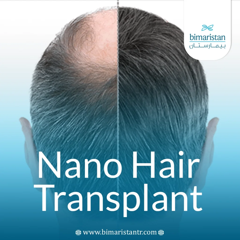 Nano Hair Transplant: Advanced Technology For Natural Results And Maximum Density 4 Nano Hair Transplant