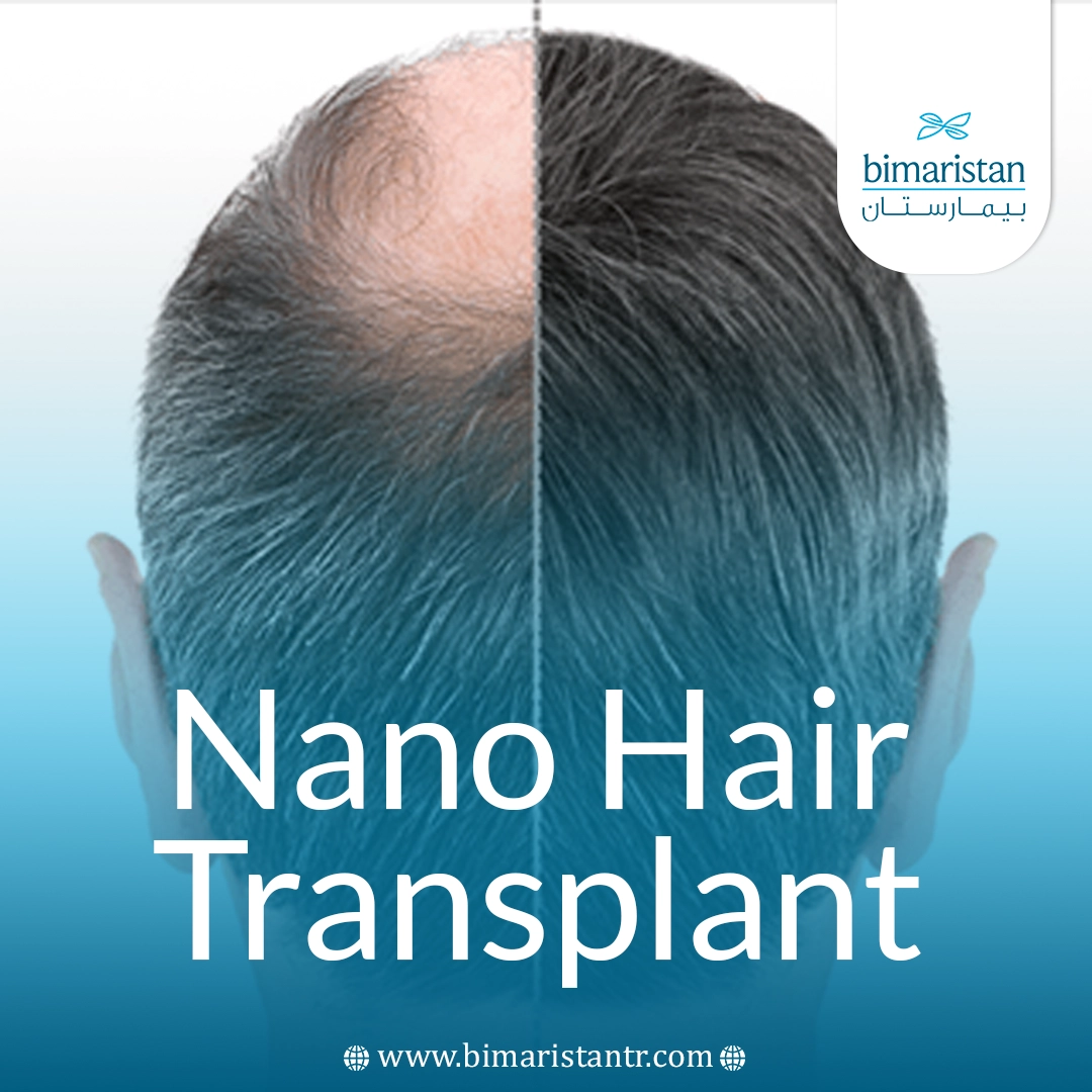 Nano Hair Transplant