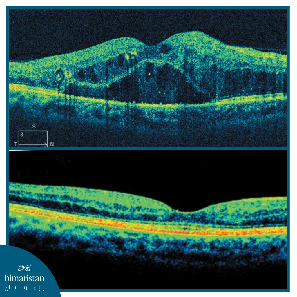 Diabetic Retinopathy Treatment In Turkey: Advanced Technologies For Vision Preservation 3 Oct Image Showing Macular Edema Before And After Treatment