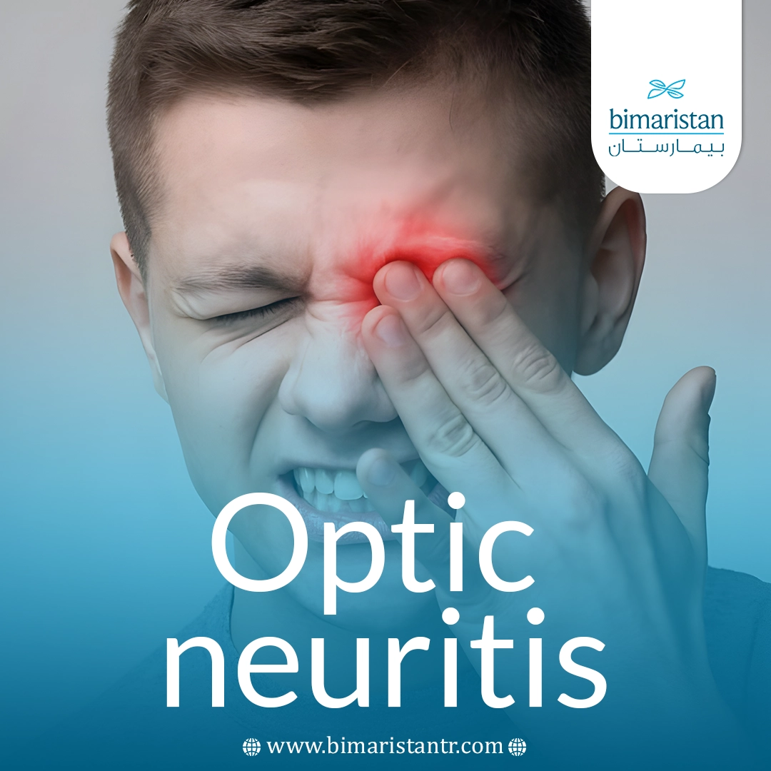 Optic Neuritis