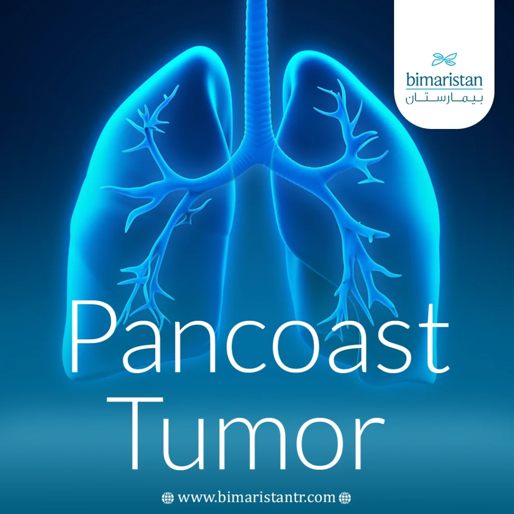 Pancoast Tumor Overview: Causes, Symptoms, And Effective Treatment Strategies 5 Pancoast Tumor