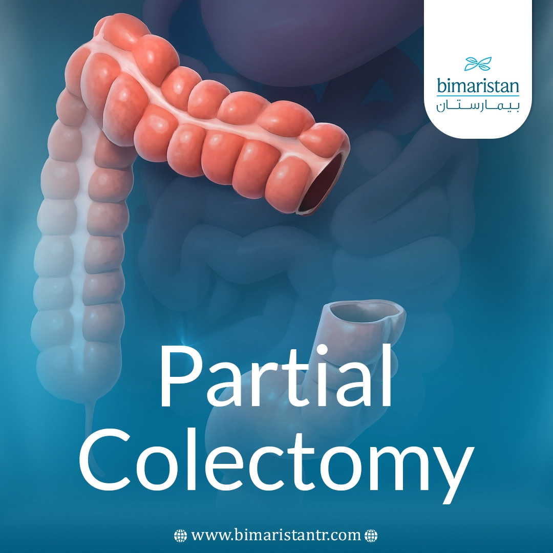Partial Colectomy