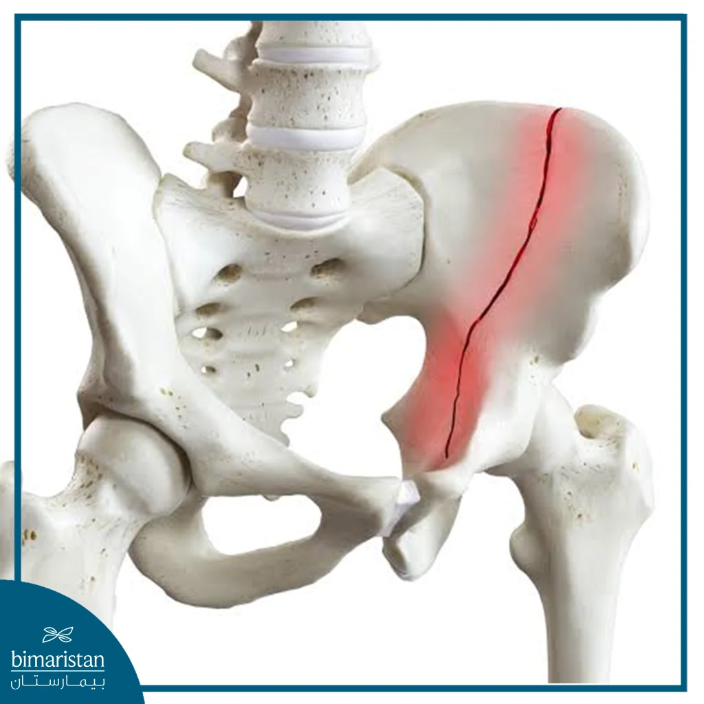 Pelvic Fractures Everything You Need To Know