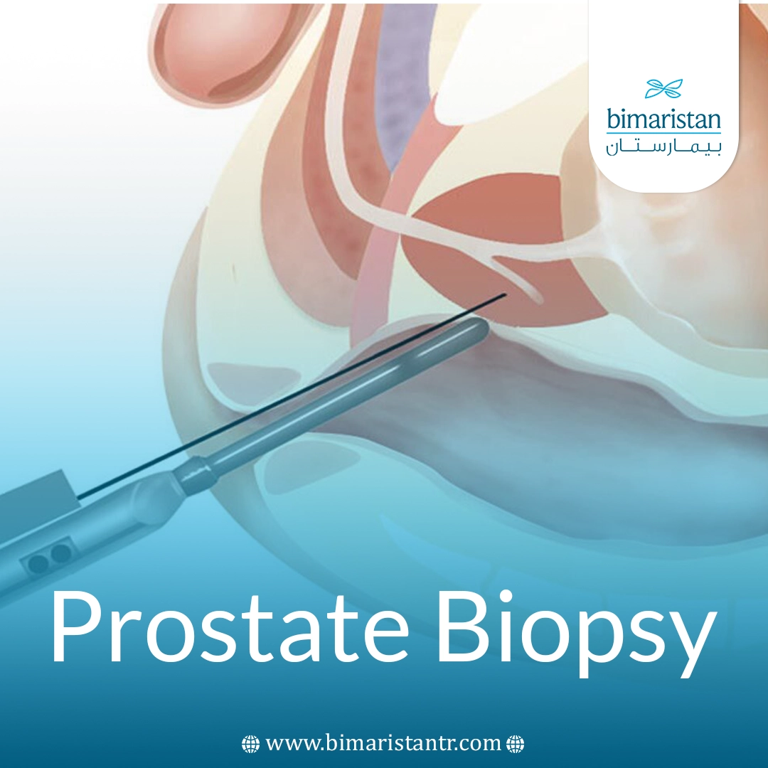 Prostate Biopsy: The Gold Standard For Prostate Cancer Detection 4 Prostate Biopsy: The Gold Standard For Prostate Cancer Detection