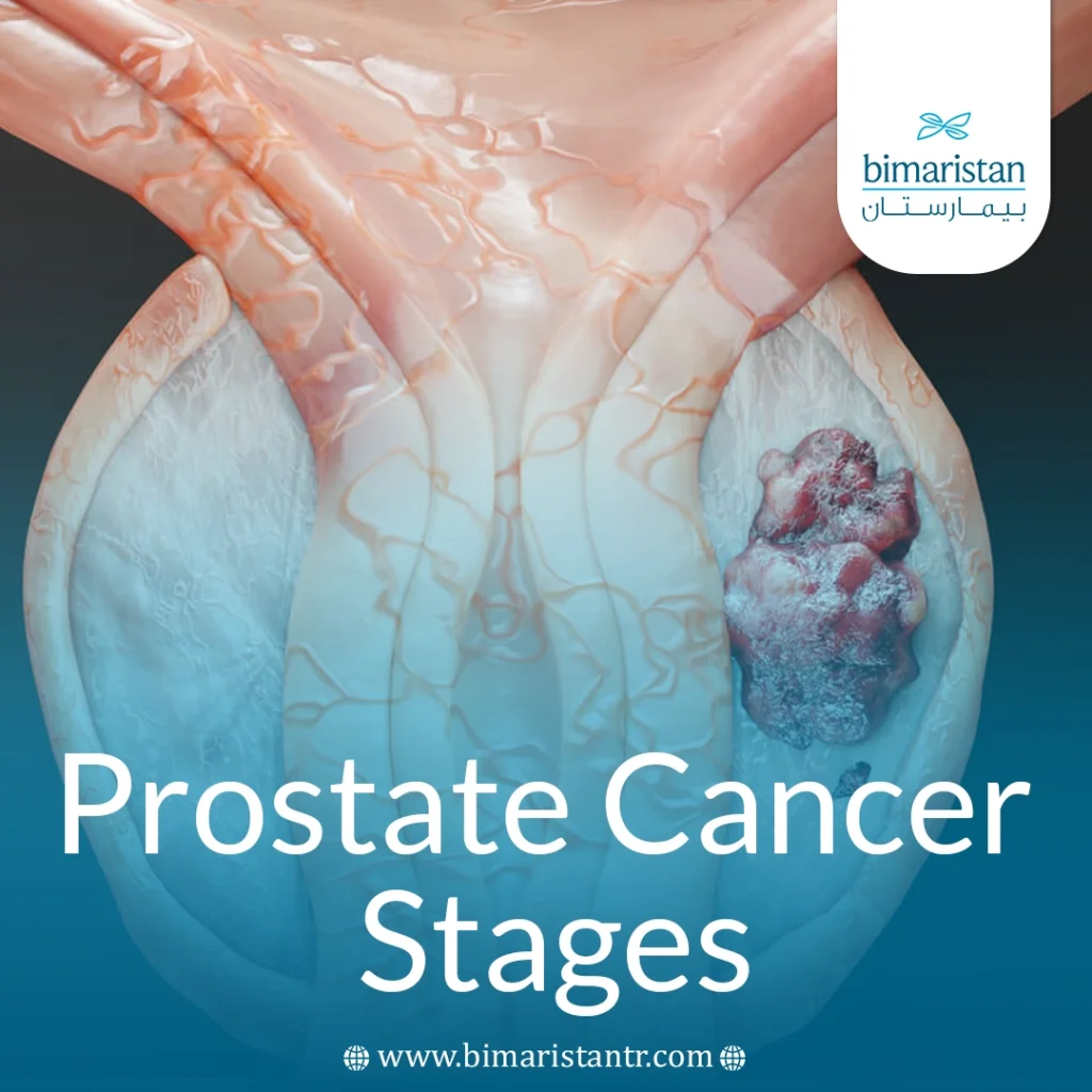 Prostate Cancer Stages