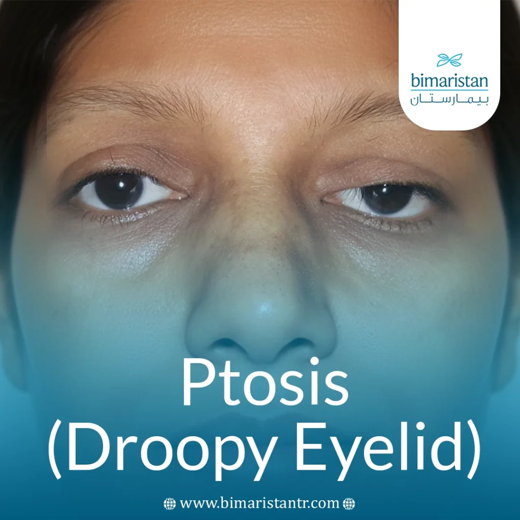 Ptosis (Droopy Eyelid)