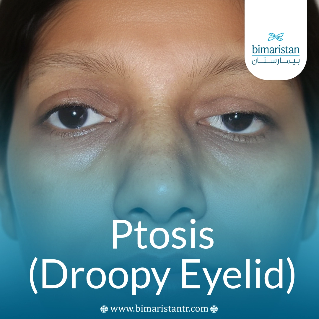 Ptosis (Droopy Eyelid)