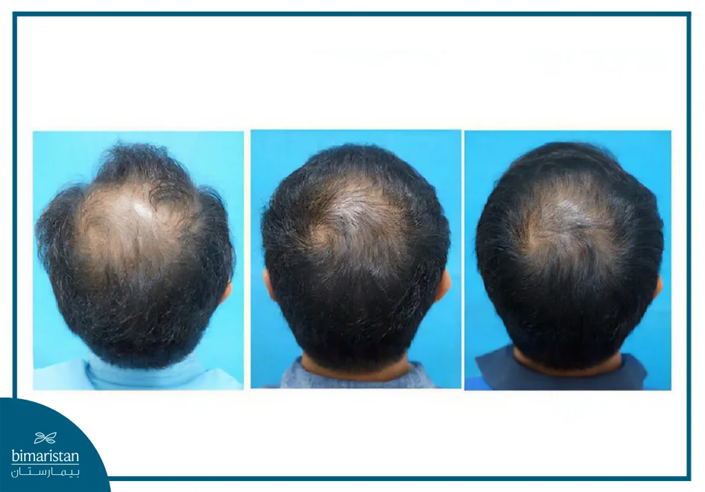 زراعة الشعر أم العلاجات الدوائية: أيهما أنسب للتخلص من تساقط الشعر؟ 3 تحسّن تدريجي في نمو وكثافة الشعر مع الاستمرار باستخدام المينوكسيديل، حيث تظهر النتائج الأولية بعد 4 أشهر وتزداد وضوحًا بعد 6 أشهر من العلاج المنتظم.