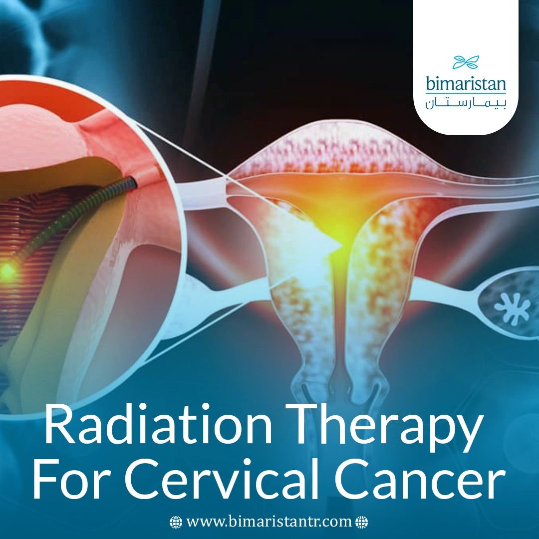 Radiation Therapy For Cervical Cancer