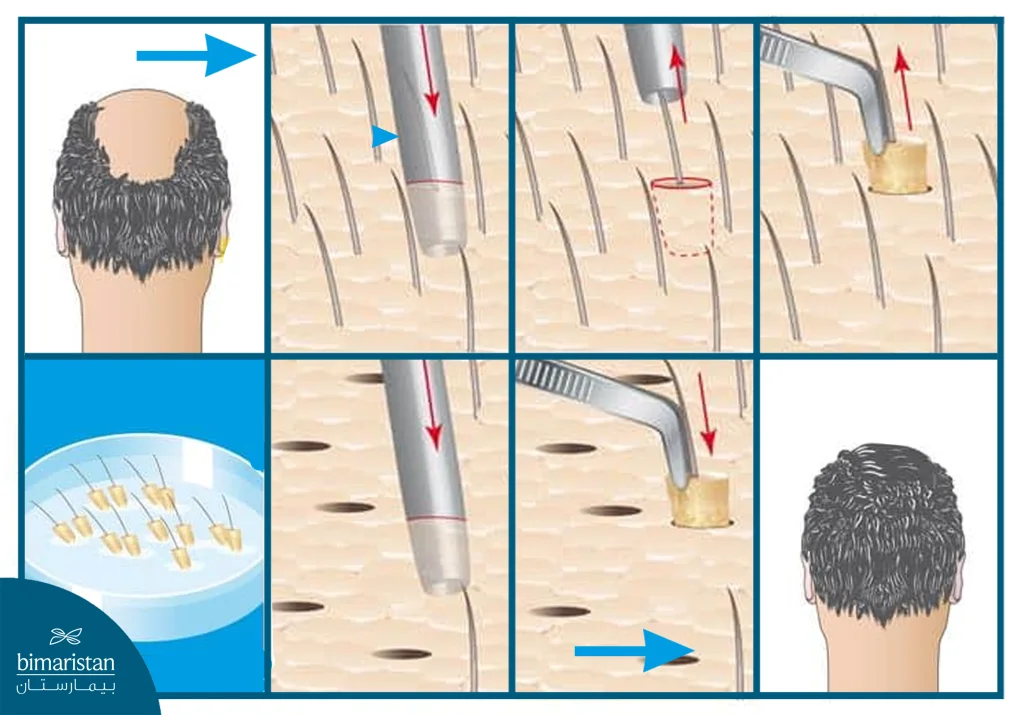 Nano Hair Transplant: Advanced Technology For Natural Results And Maximum Density 2 Stages Of Nano Hair Transplant From Extraction To Precise Implantation Of The Follicles.