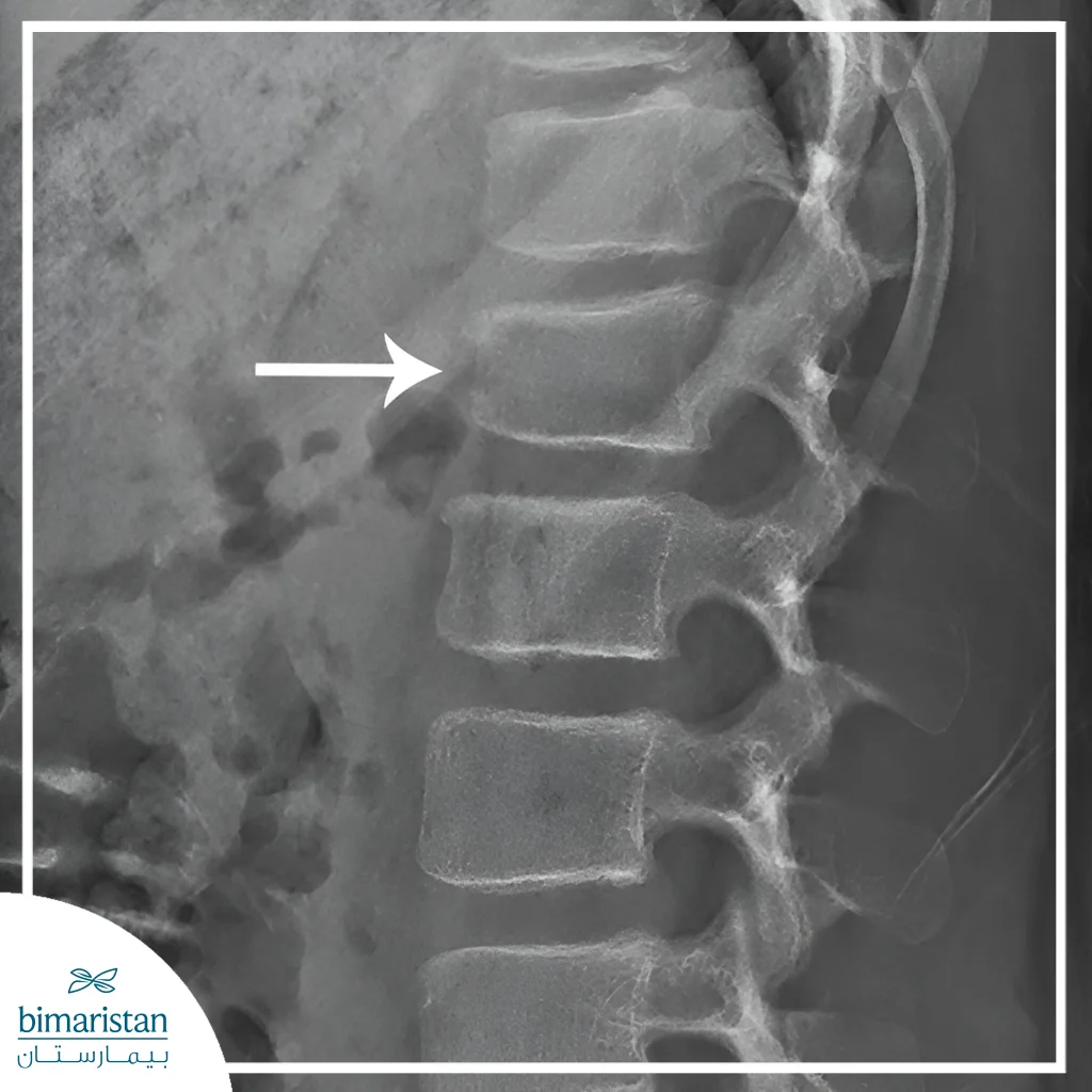 The X-Ray Here Shows A Compression Fracture Of The Spine (Demonstrating A Loss Of Vertebral Height).