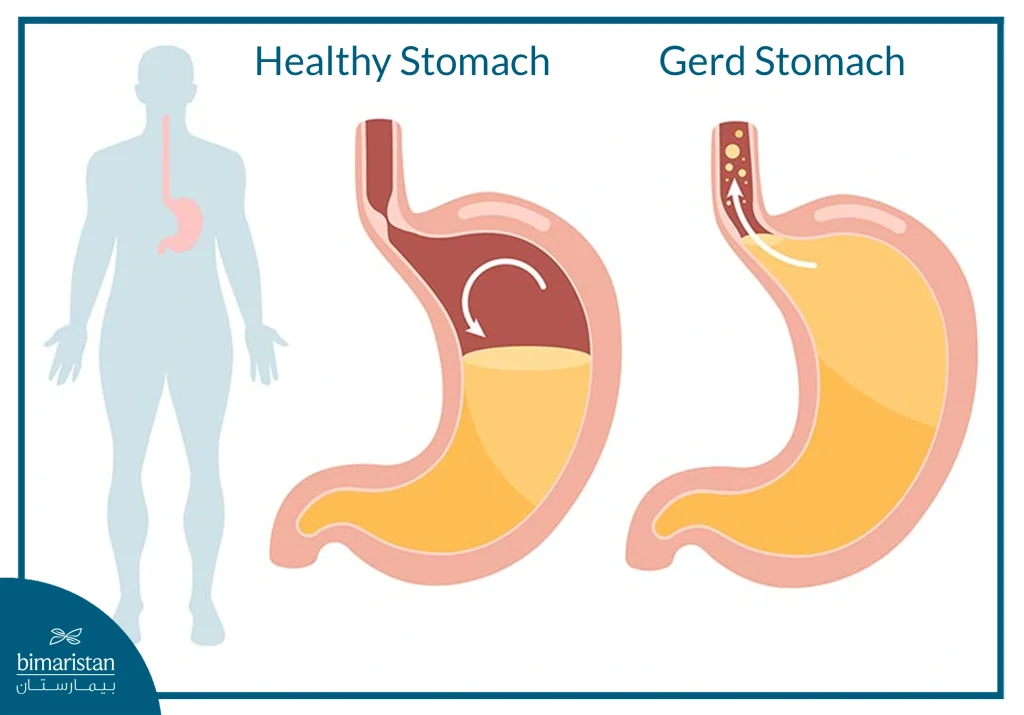 Gerd Surgery: When To Use It And What Are The Chances Of Success? 3 The Difference Between A Healthy Stomach And One With Gastroesophageal Reflux Disease (Gerd)