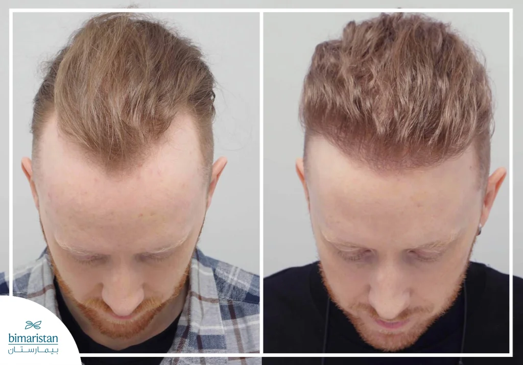 The Difference Between Transplanted Hair And Natural Hair