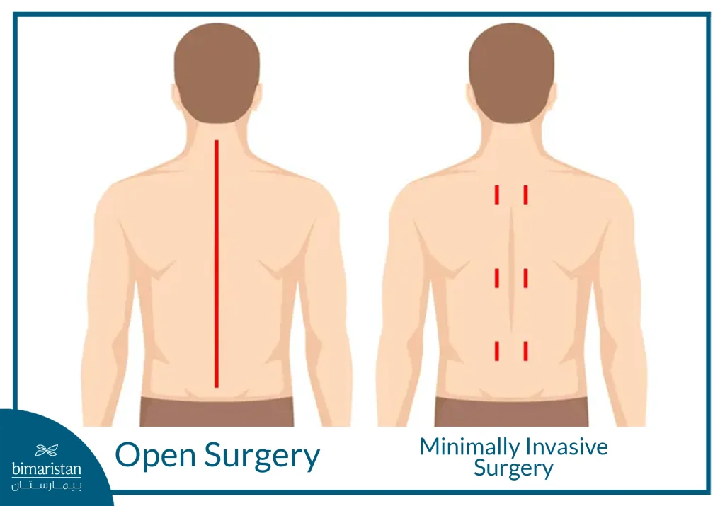The Difference In Incision Size Between Open Surgery And Minimally Invasive Surgery