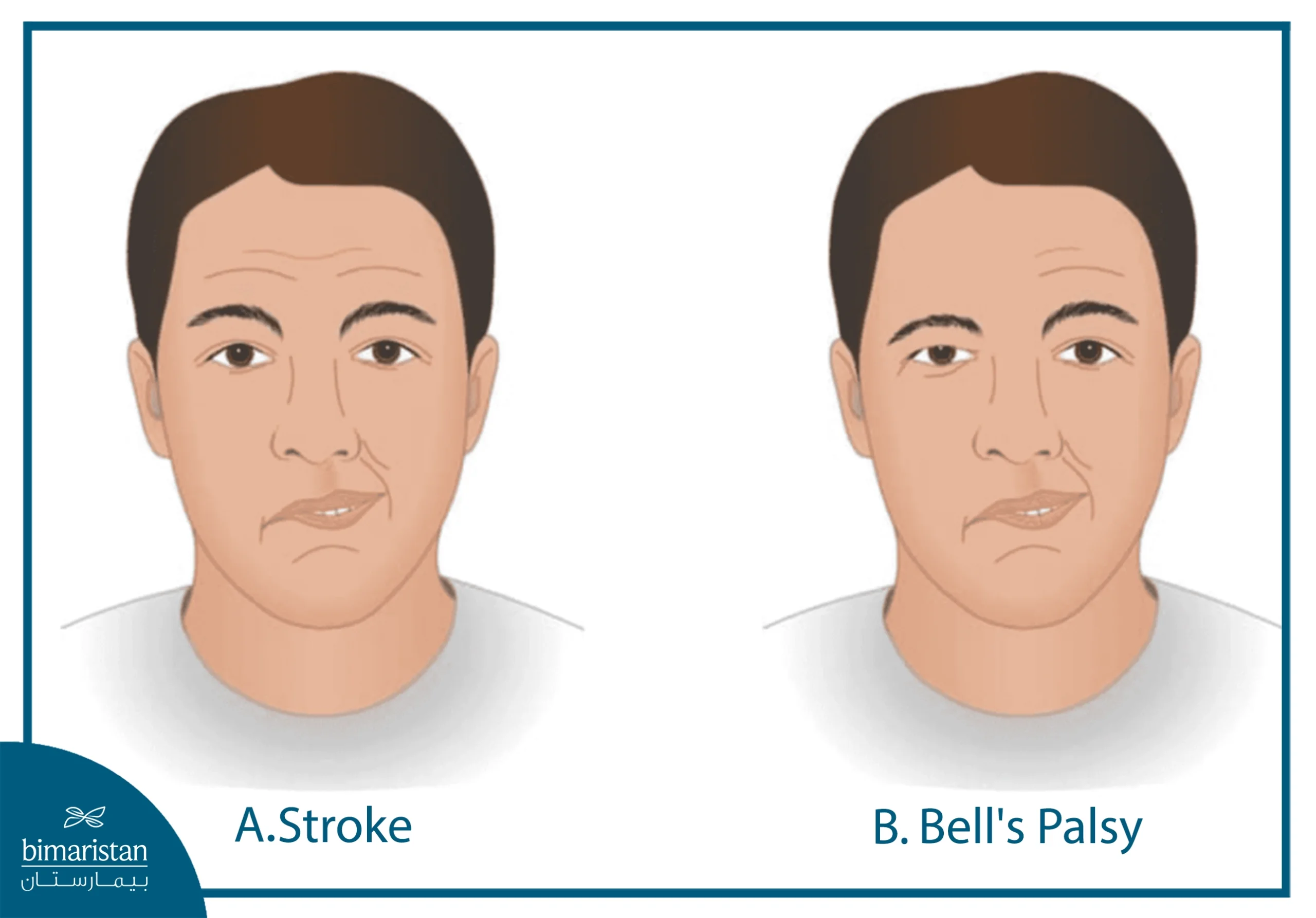 Facial Nerve Palsy: Causes And Treatment 4 The Image Demonstrates The Absence Of Forehead Wrinkles In Bell’s Palsy, In Contrast To Stroke.