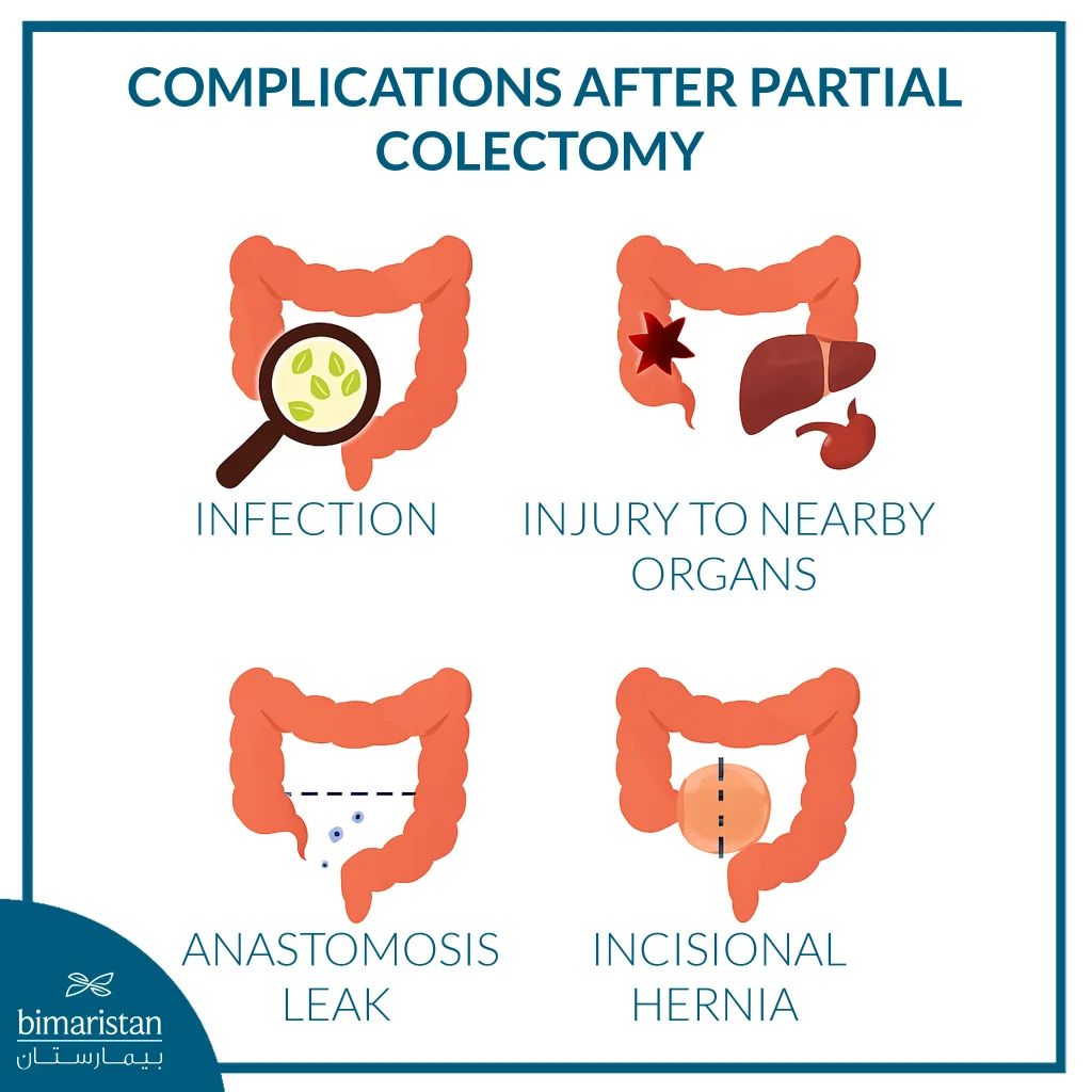 Partial Colectomy: When Is It Recommended And What Are The Results Of The Surgery? 5 The Image Illustrates Some Complications Of Partial Colectomy
