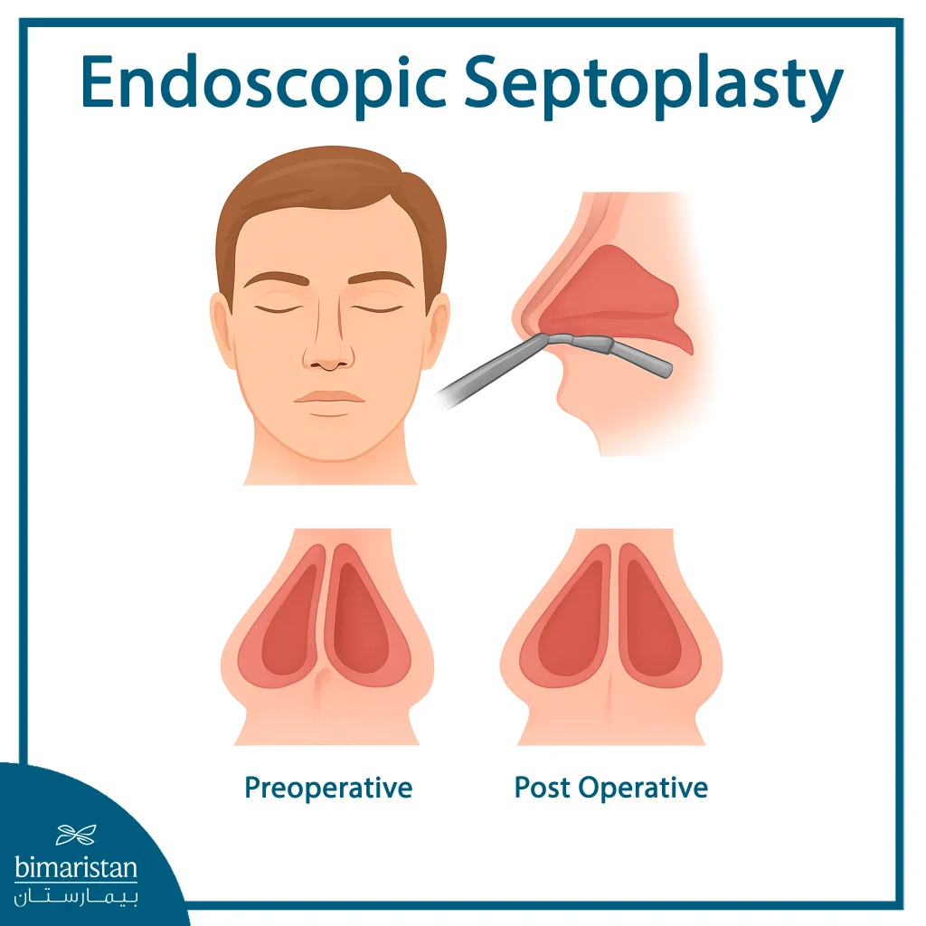 The Image Illustrates The Difference In The Shape Of The Nasal Septum After Endoscopic Septoplasty