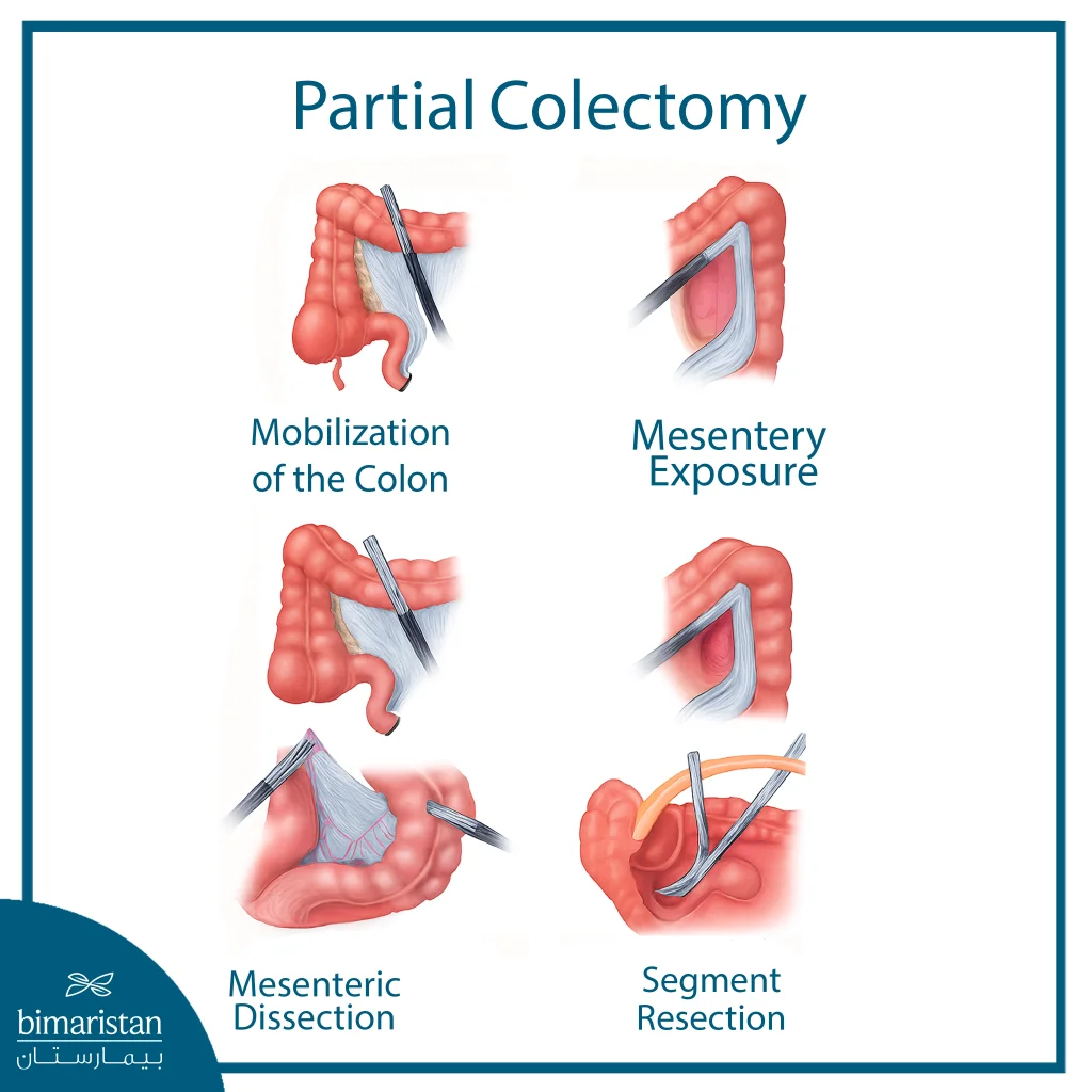 Partial Colectomy: When Is It Recommended And What Are The Results Of The Surgery? 4 The Image Illustrates The Steps Of Partial Colectomy