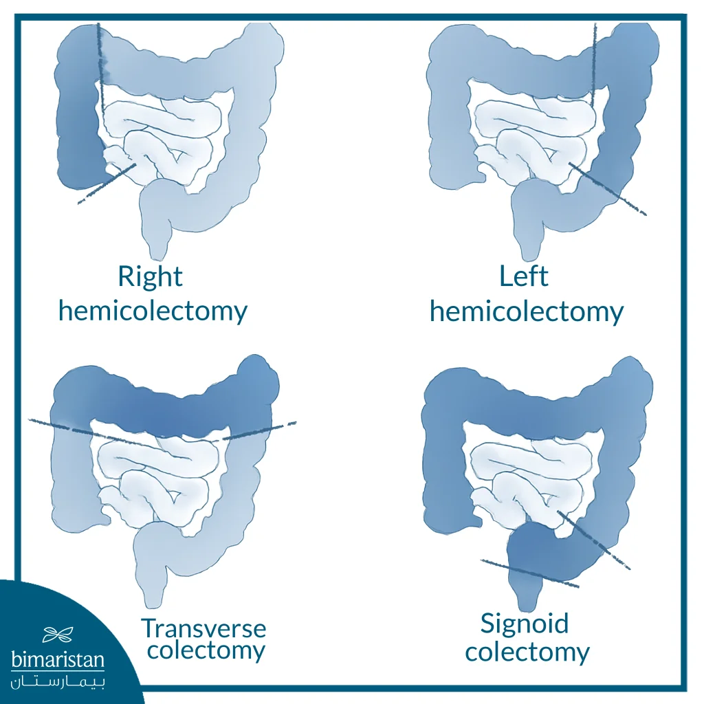 Partial Colectomy: When Is It Recommended And What Are The Results Of The Surgery? 3 The Image Illustrates The Types Of Partial Colectomy