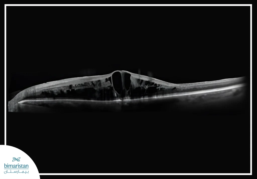 The Image Showing Macular Edema In The Retina On Oct Scan