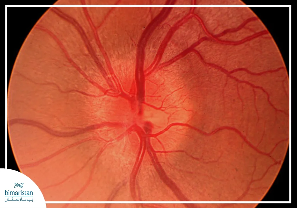 The Image Showing The Appearance Of Optic Neuritis During A Fundoscopic (Ophthalmoscopic) Examination.