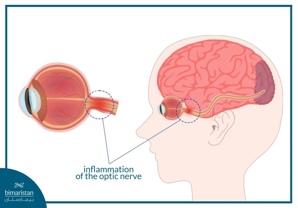 The Image Showing The Location Of Inflammation In Optic Neuritis