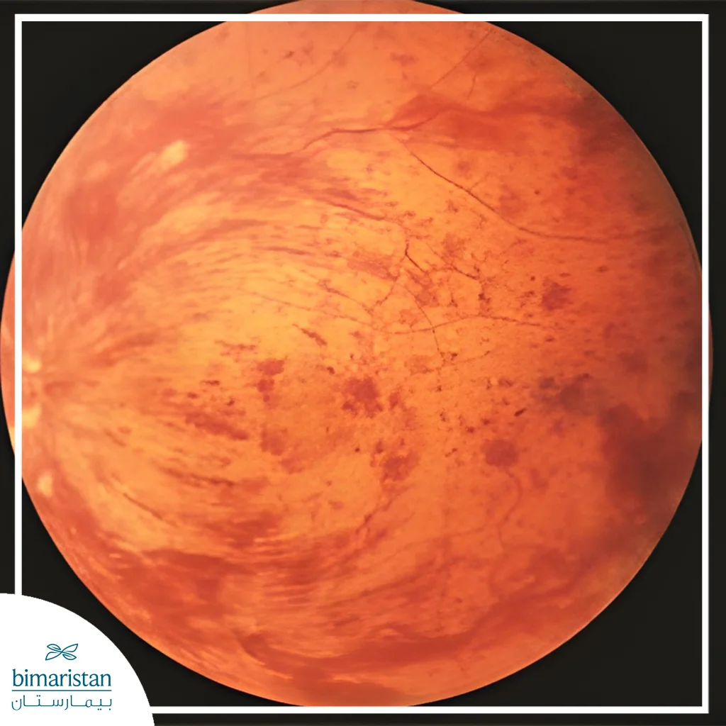 The Image Showing Widespread Retinal Hemorrhages And Swelling Typical Of Central Retinal Vein Occlusion
