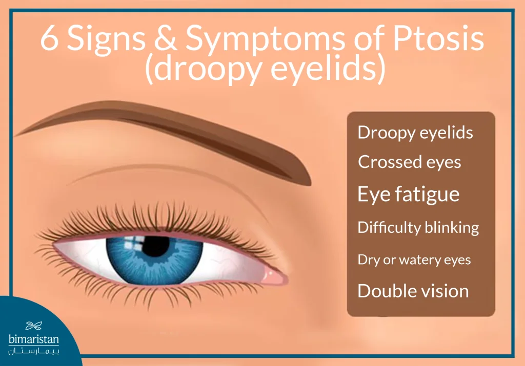 The Image Shows Six Signs And Symptoms Of Ptosis In Adults And Children