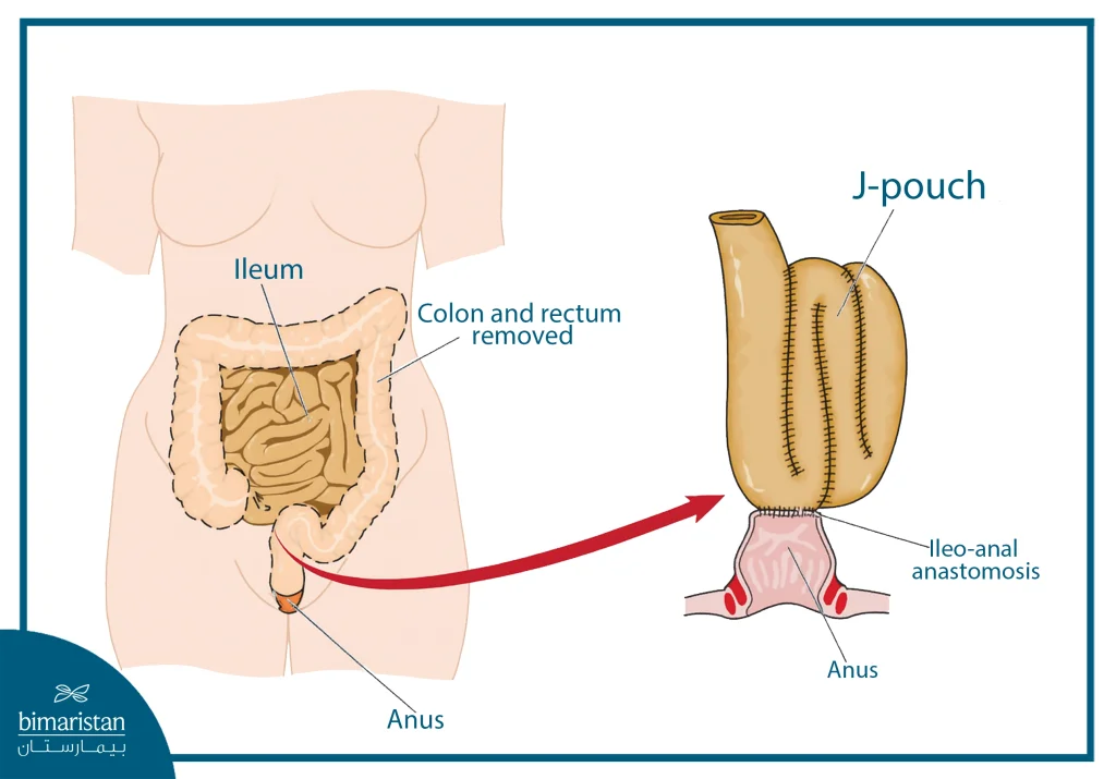 The Image Shows A Colectomy And Rectum With A J-Pouch.