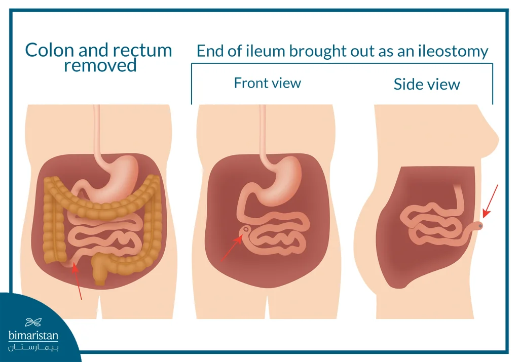 The Image Shows A Colectomy, Proctectomy, And Anal Resection With Terminal Ileostomy.