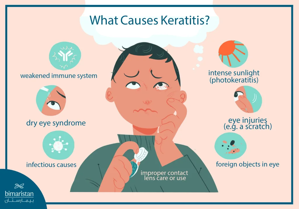 Keratitis: Discover Its Causes, Symptoms, And How It’s Treated 2 The Image Shows Common Causes Of Keratitis, Including Infection, Dry Eye, Uv Exposure, Contact Lens Misuse, And Eye Injury