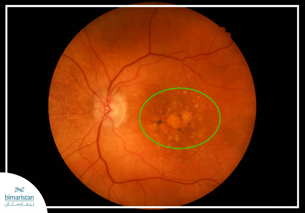 The Image Shows The Late Stage Of Dry Macular Degeneration.