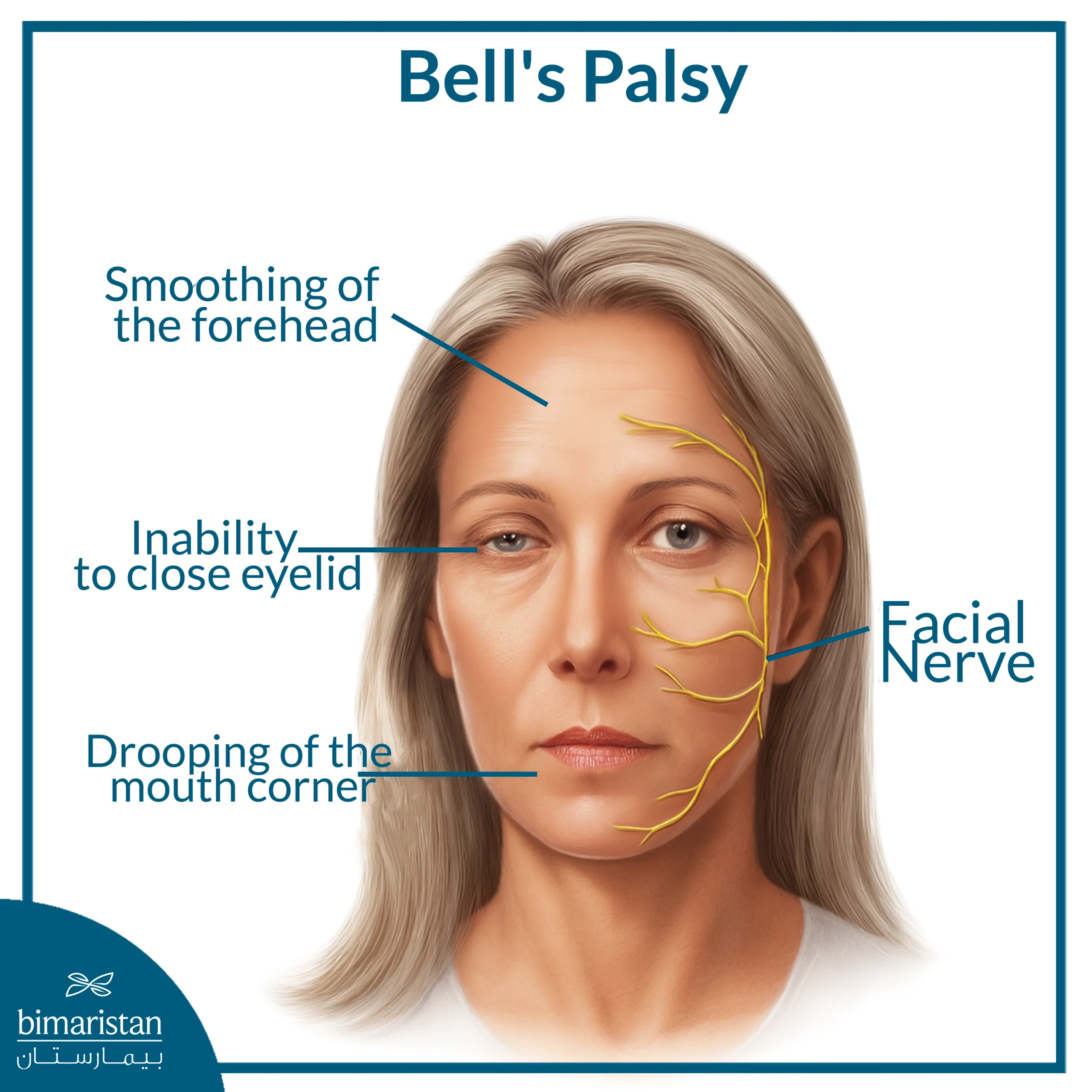 Facial Nerve Palsy: Causes And Treatment 2 The Image Shows The Location Of The Facial Nerve And Some Symptoms Of Bell’s Palsy