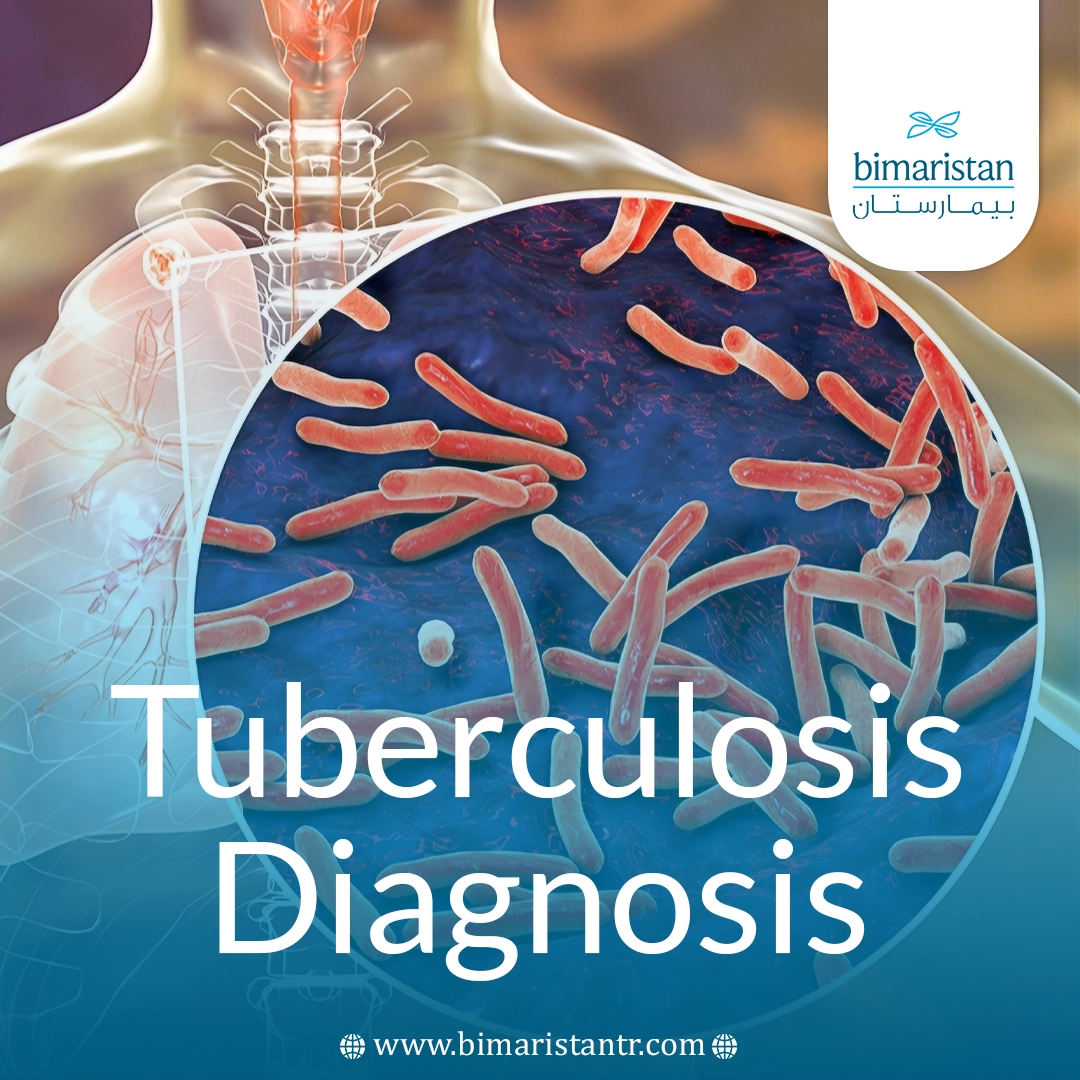 Tuberculosis Diagnosis