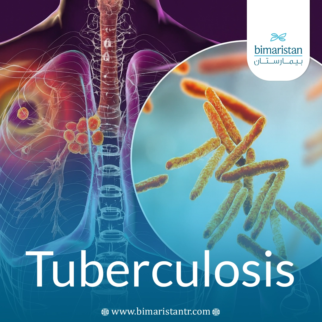 Tuberculosis