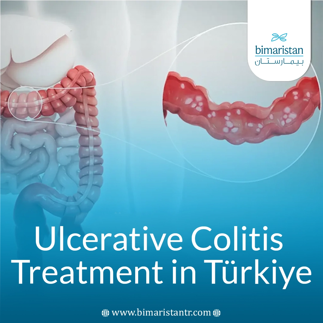 Ulcerative Colitis Treatment In Türkiye