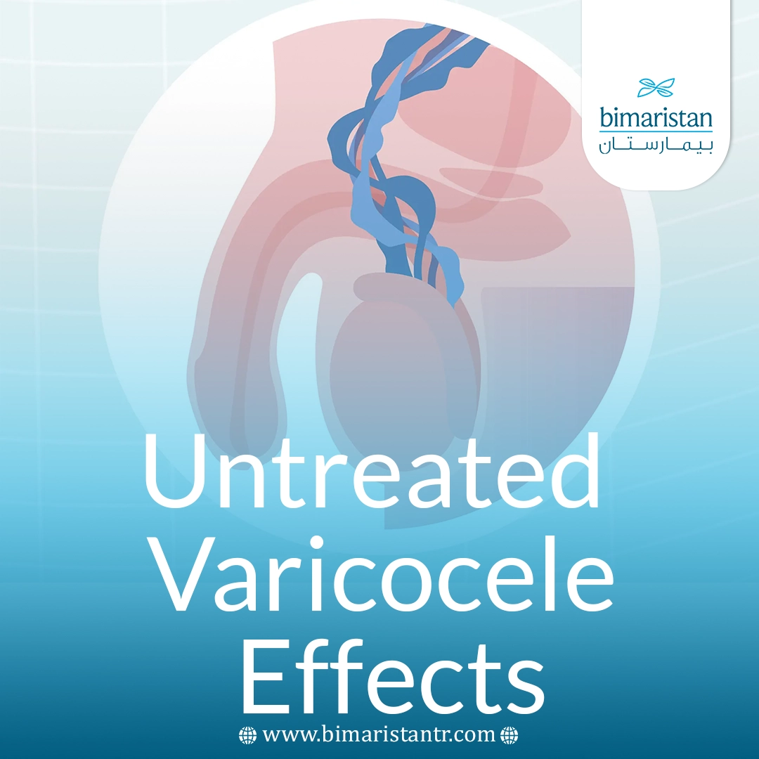 Untreated Varicocele Effects
