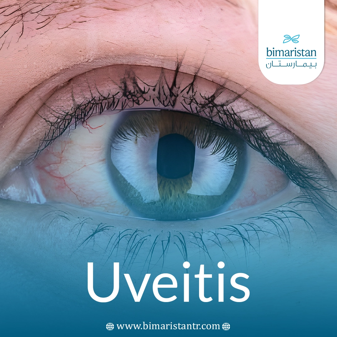 Uveitis 101: Symptoms, Causes &Amp;Amp; Treatment Explained 3 Uveitis 101: Symptoms, Causes &Amp;Amp; Treatment Explained
