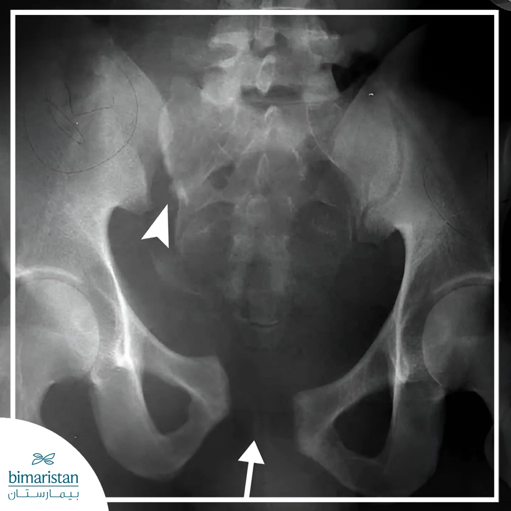 X-Ray Image Showing A Clear Pelvic Fracture