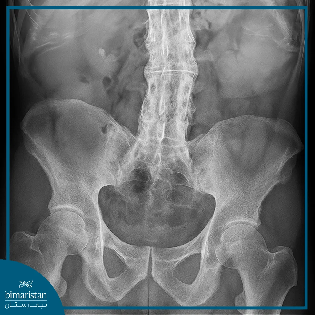 X-Ray Image Showing Ankylosing Spondylitis
