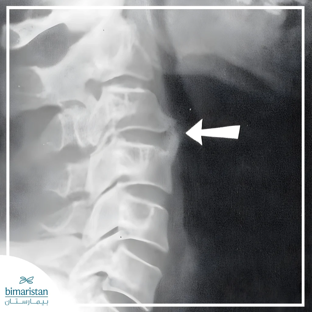X-Ray Image Showing Cervical Bone Spur
