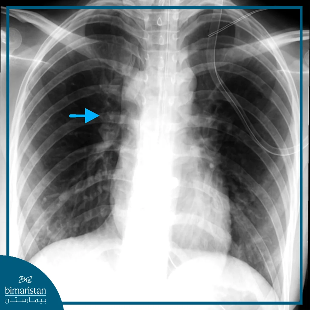 X-Ray Image Showing A Clear Esophageal Perforation