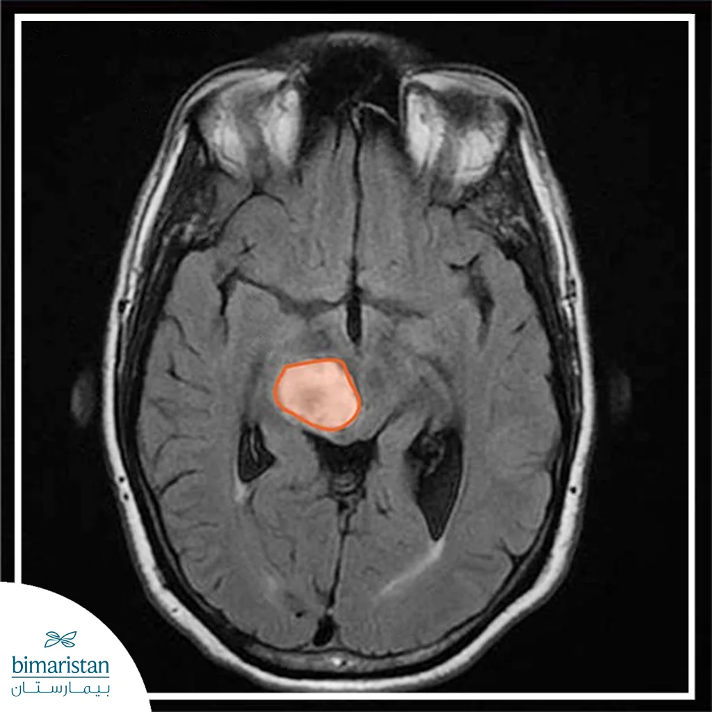 X-Ray Of A Brain Tumor